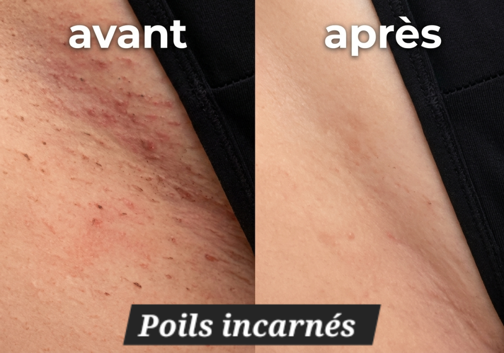 poils incarnés